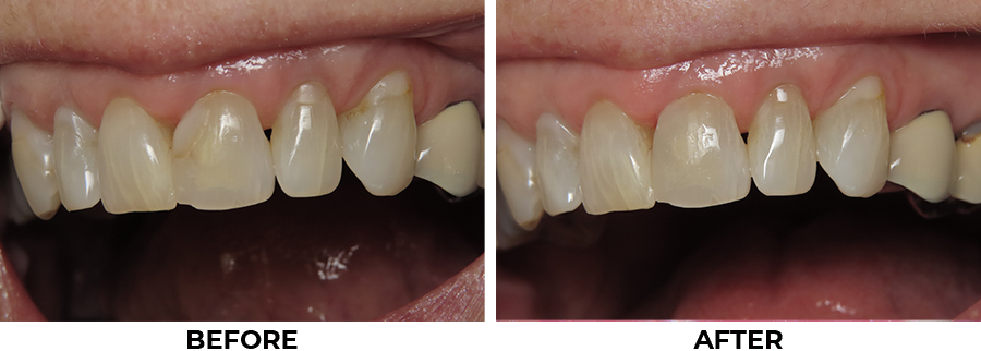 Before & After Photos, Tooth-Colored Fillings Gallery